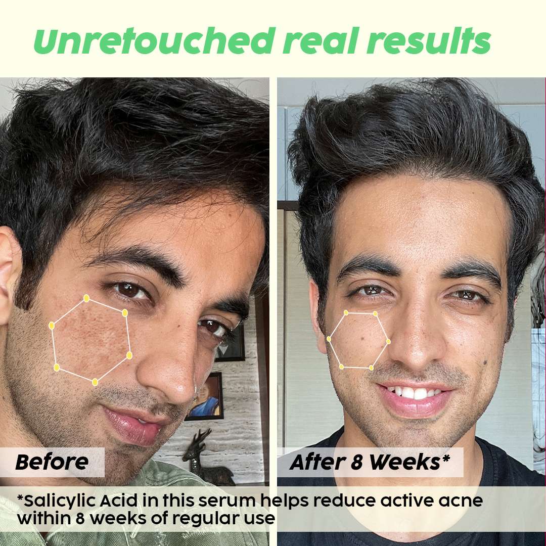 Get Plix 2 Salicylic Acid Serum for Active Acne & Blackheads